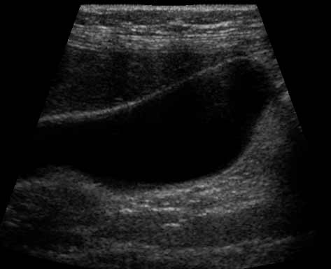 Ultrasound of the gallbladder. The wall or lining of the gallbladder is white, the bile within the gallbladder is mostly made of water and it appears as a clear black space within the walls of the gallbladder.