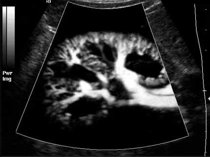 Power Doppler ultrasound of the kidney. This image shows the tiny blood vessels in the kidney like the branches of a tree.