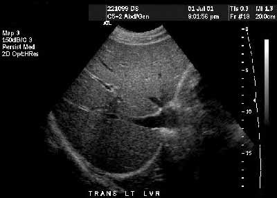 Ultrasound of the liver. This image demonstrates the liver tissue. The darker linear areas in the liver are veins bringing blood and nutrients to the liver and others are draining blood from the liver and returning it to the heart.