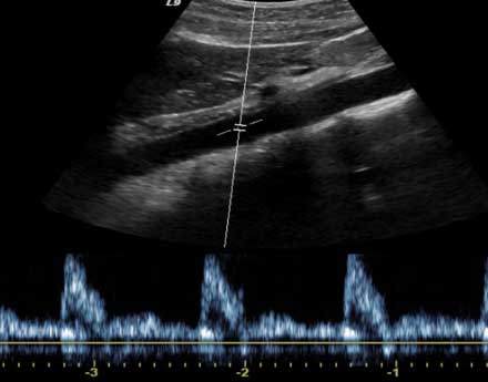 Ultrasound, abdominal aorta with Doppler wave form— side view: patient's head to left.