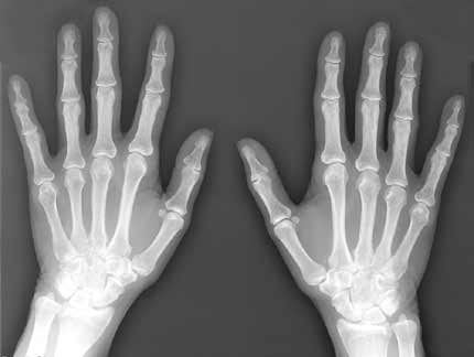 X-ray showing frontal view of both hands.