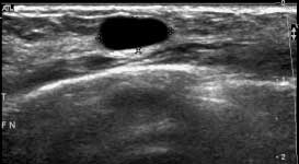 Ultrasound of benign cyst. A cyst is a non-cancerous fluid-filled structure in the breast. Ultrasound is necessary to make the diagnosis.