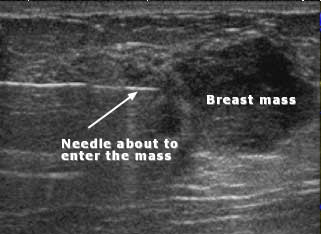 Ultrasound-guided biopsy of a solid breast mass shows biopsy needle about to enter the mass.