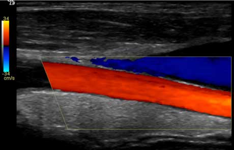 Right Common Carotid ArteryColor Doppler Ultrasound.