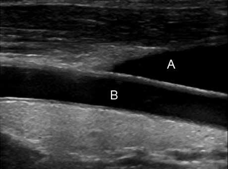 Image of carotid arterypatient lying down, head to left. <br />a. jugular vein <br />b. right common carotid artery