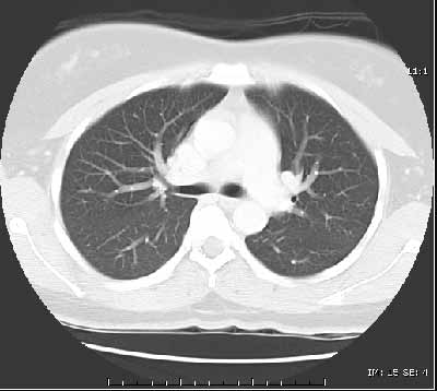 CT of the lungs, window level set to demonstrate the vessels and air ways - not intended to demonstrate the heart, spine muscles etc. This is used to look for things like pneumonia or lung cancer.