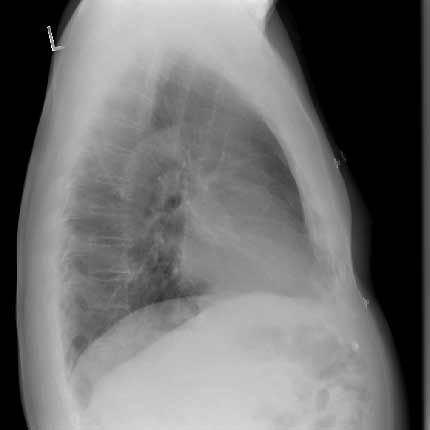 Chest x-ray. Side view or lateral view of the chest.