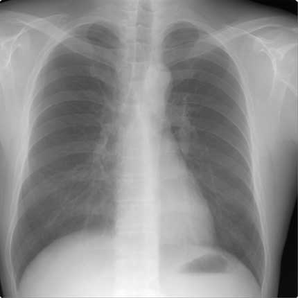 Chest x-ray. Frontal view of a male patient.