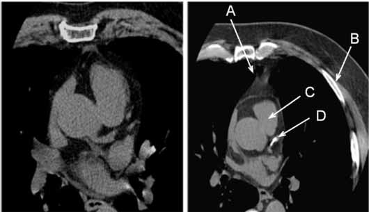 <em>(Left)</em> CT of normal coronary artery.<br /><br /> <em>(Right)</em> Abnormal CT showing calcium in the left coronary artery. <br />A: sternum <br />B: rib<br /> C: heart<br /> D: calcium in the coronary artery