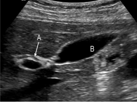 Gallbladder and common bile duct.<br />a. common bile duct<br />b. gallbladder