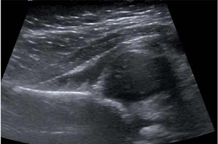 5 month old female: hip evaluated for congenital dysplasia<br /> Ultrasound showing a dislocated hiphead of femur out of alignment with hip socket.
