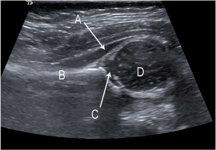5 month old female: hip evaluated for congenital dysplasia<br />  Ultrasound of a normal hip.<br />a. gluteus muscle<br />  b. ilium<br />  c. acetabulum<br />  d. head of femur