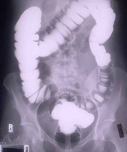 Normal air contrast barium enema