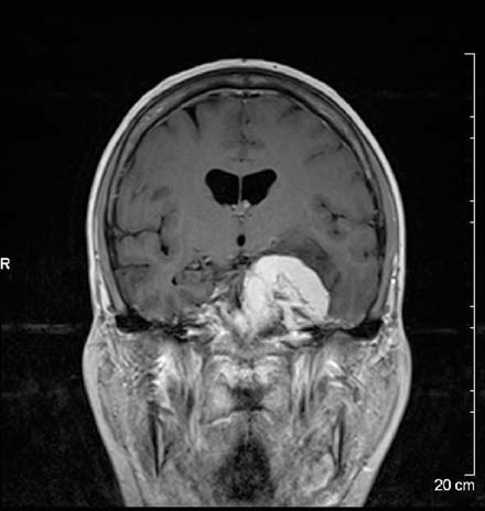 Meningioma centered in the left mid skull base.