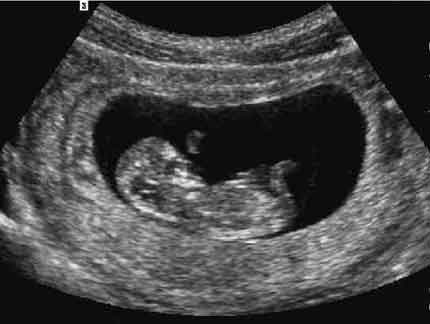 Fetal profile 1st trimester