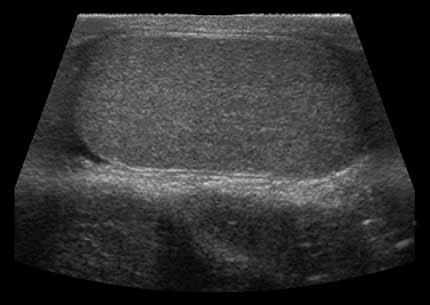 Scrotal sonogram showing side view (longitudinal) of a testicle. Patient's head to left and feet to right out of the field of view.
