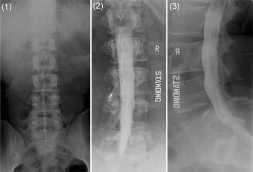Preliminary view (1) of lumbar spine. Front (2) and side (3) views during a myelogram with iodine in the spinal canal.