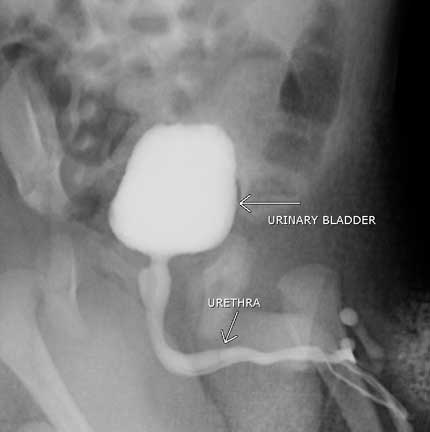 Voiding cystourethrogram. Oblique view of a young male during voiding.