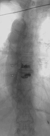 Image of the spine after having vertebroplasty of the 8th and 9th thoracic (mid back) vertebrae.