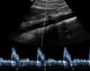 Doppler ultrasound wave form