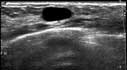 breast ultrasound image