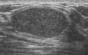 Breast ultrasound image