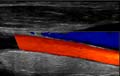 Right Common Carotid Artery—-Color Doppler Ultrasound.