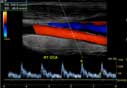 Right common carotid artery. Doppler wave form added at the bottom.