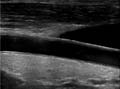 Image of carotid artery -- patient lying down, head to left.
