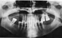A panoramic x-ray image