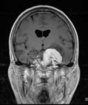 Image of a brain tumor
