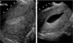 Hysterosonogram image
